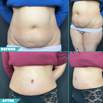 Abdominoplasty