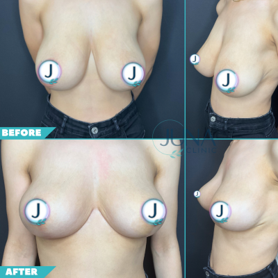 Breast Reduction 1