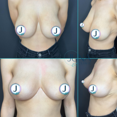 Breast Reduction+Uplift 3