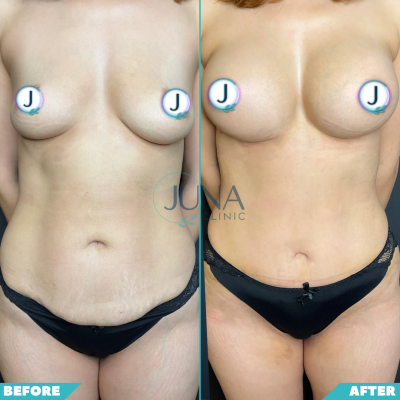 Mini Abdominoplasty+Breast Implant