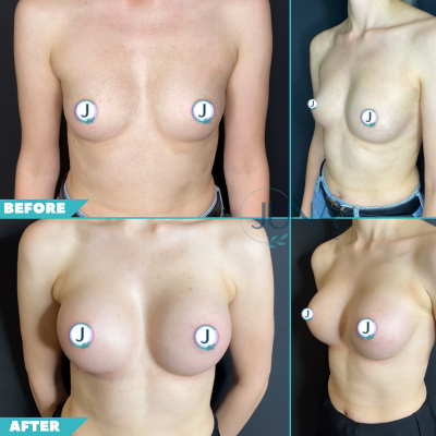 breast implnat 2