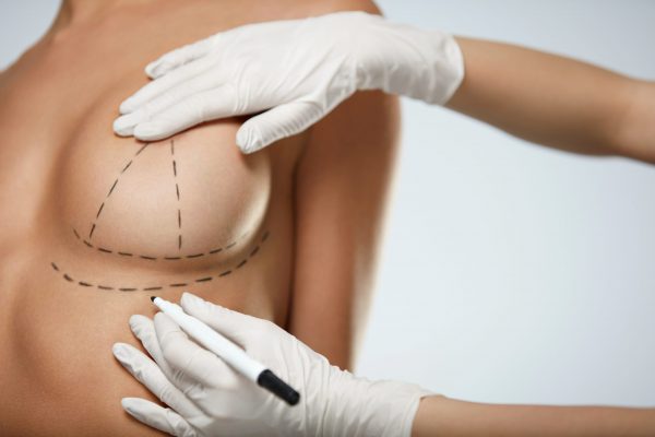 Breast,Augmentation.,Closeup,Beautician,Hands,In,Gloves,Drawing,Surgical,Lines