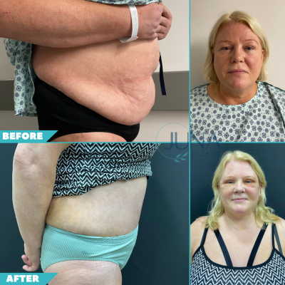 face lift and tummy tuck