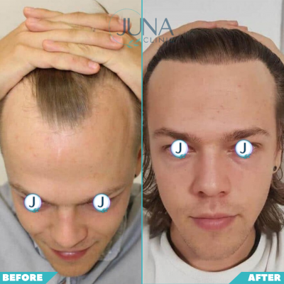 hair transplant 3