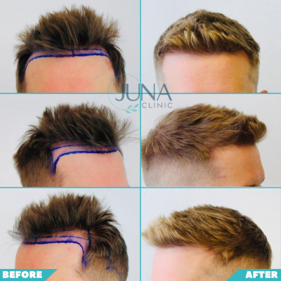 hair transplant 4