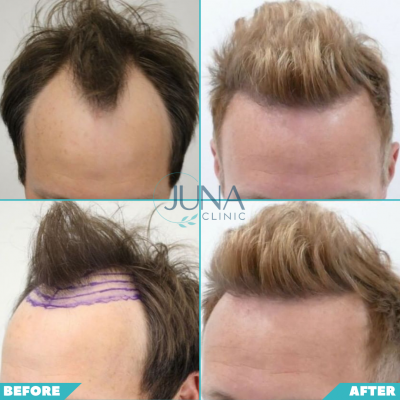 hair transplant 5