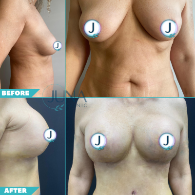 tummy tuck and breast lift 1